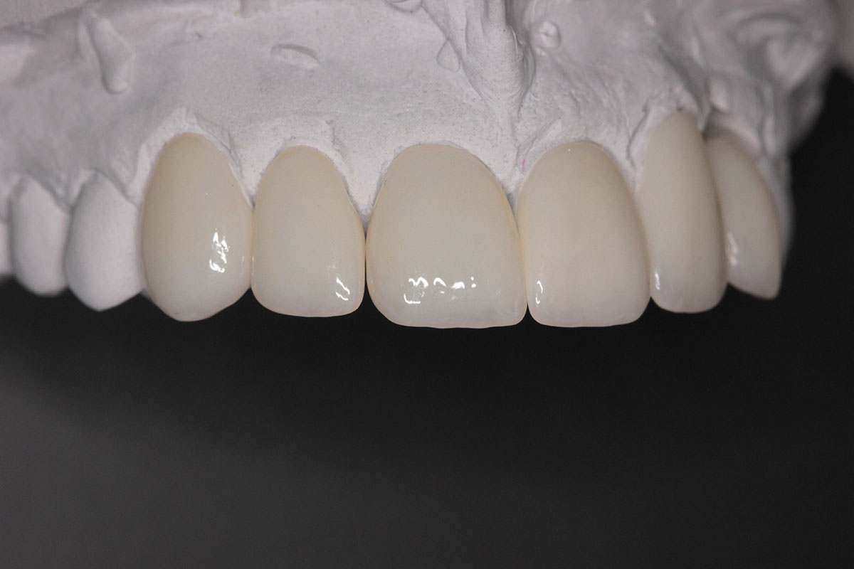 Fractures of the tooth crown, tooth for implantation procedure