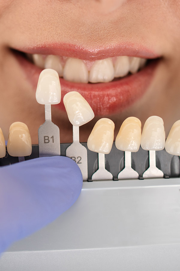 Composite veneers, porcelain veneers, ceramic veneers